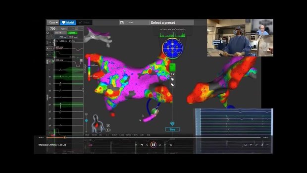 Integrating Mapping and More Versatile PFA Ablation for Tailored ...