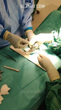 Quad Tendon (QT) and Adjustable Ultrabutton Construct - a Rip Stop ...