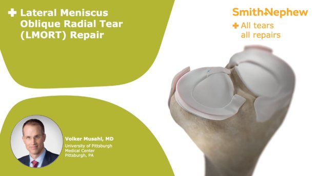 Lateral Meniscus Oblique Radial Tear (LMORT) Repair | Vumedi