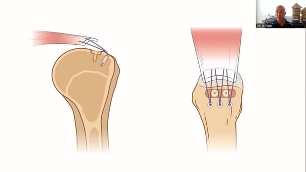 Single Row Rotator Cuff Repair Technique With Orthobiologic ...
