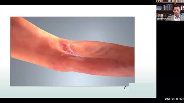 One-Year Outcomes of the VENOS-1 Trial - A Novel Percutaneous ...
