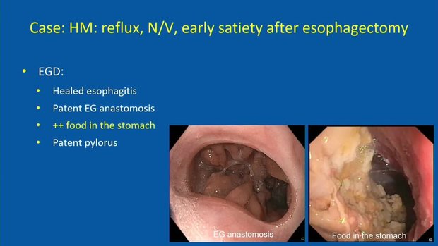 Reflux in Upper GI Cancers After Esophagectomy: Overview and Management ...