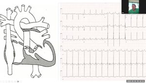 HRS 2025 Insights: Early Experience in Atrial and Dual Chamber Leadless ...