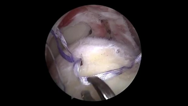 Reduction of a Massive L-shaped Rotator Cuff Tear Using All