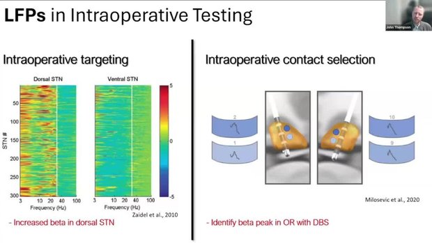 What is DBS?: What are Local Field Potentials and Why Are They ...