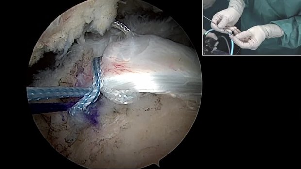 Partial RC Repair and Biceps SCR | Vumedi