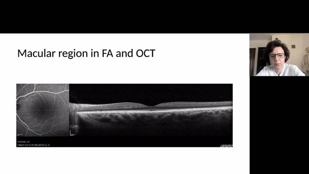 Simultaneous OCT and FA Retinal Imaging | Vumedi