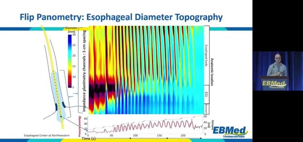 How I Do It: Esophageal Diagnostics with EndoFLIP, Bravo, and Manometry ...
