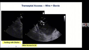 How to Succeed on Difficult Transeptal Punctures | VuMedi