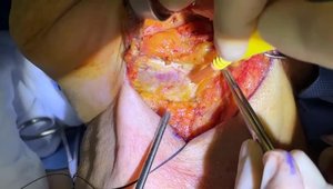 Supraomohyoid Neck Dissection with Submandibular Gland Preservation ...