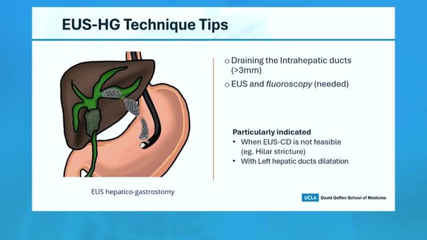 Ercp Stent Placement