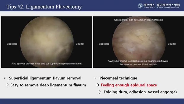 Biportal Endoscopic Decompression in Lumbar Spinal Stenosis - How to ...