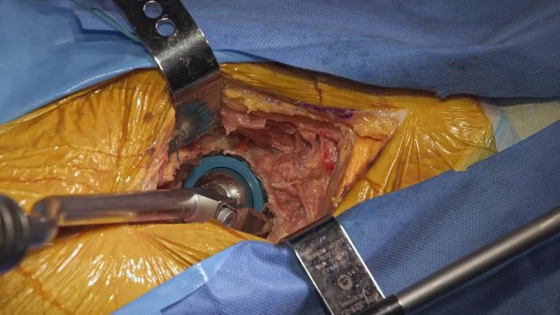 Automated Acetabular Cup Extraction in Revision THA | Vumedi