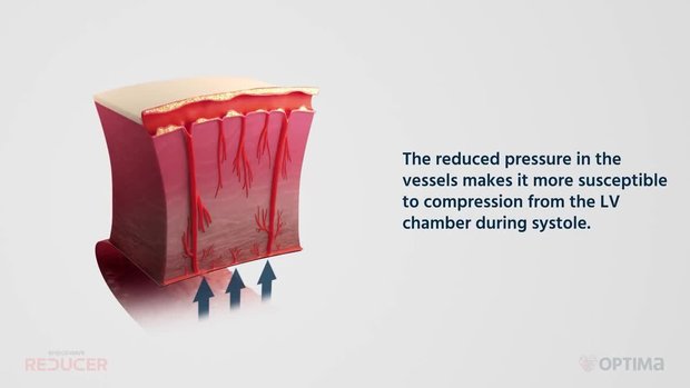 Shockwave Medical | Vumedi