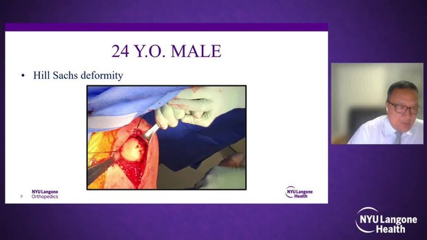 Instability With Bone Loss | Vumedi
