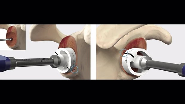 Reverse Shoulder Arthroplasty Glenoid Preparation | Vumedi