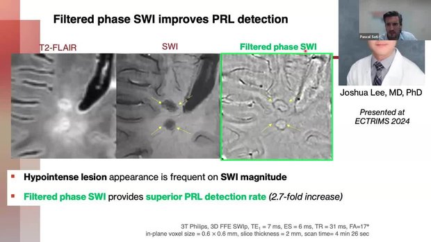 MR Imaging of the Central Vein Sign and Paramagnetic Rim Lesions | Vumedi
