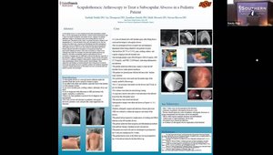Scapulothoracic Arthroscopy to Treat a Subscapular Abscess in a ...