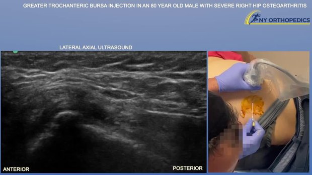 Greater Trochanteric Bursa Injection in an 80 Year Old Male With Severe ...