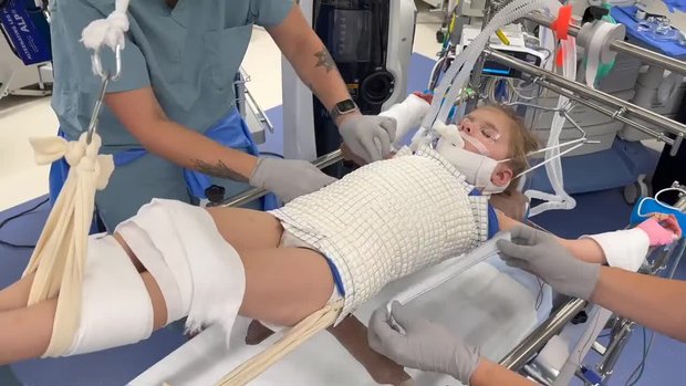 Waterproof Spinal Body Casting for Scoliosis | Vumedi
