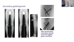 Physeal Bar Resection Case Discussion | Vumedi