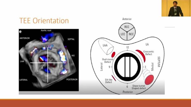 Severe Paravalvular Leak (PVL) and Transcatheter PVL Closure, Bridging ...