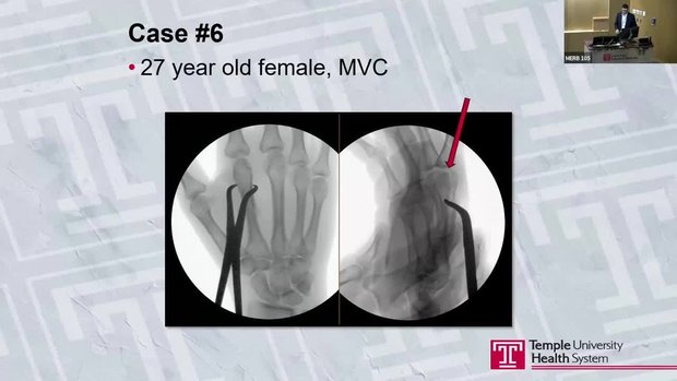 Case Presentation: 27 yo Female With Malrotation After a MVC | Vumedi