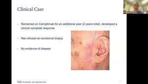 Neoadjuvant Cemiplimab for Squamous Cell Carcinoma | Vumedi