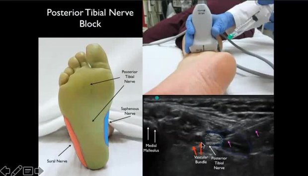 where to inject bpc 157 for ankle injury Injections Around The Ankle and Foot Overview - Everything You Need To Know