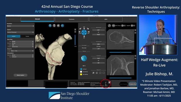 Reverse Shoulder Arthroplasty Techniques: Half-Wedge Augment Re-Live ...