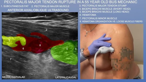 Pectoralis Major Tendon Rupture in a 55 Year Old Bus Mechanic | Vumedi