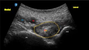 PENG Block: Targeting the Capsule, Sparing the Motor | Vumedi
