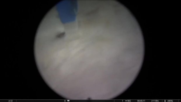 HoLEP in 400g Prostate | Vumedi
