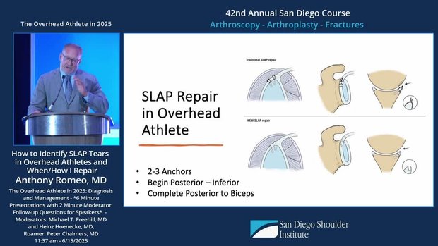 How to Identify SLAP Tears in Overhead Athletes and When/How I Repair ...