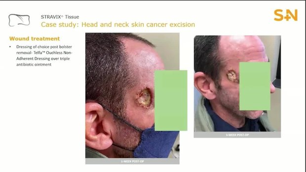 Benefit of CAMPs in the Surgical Treatment of Oncologic Patients - Case ...