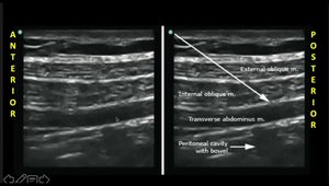 Practical Guide to TAP Blocks: From Anatomy to Clinical Use | Vumedi