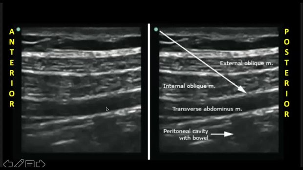 Practical Guide to TAP Blocks: From Anatomy to Clinical Use | Vumedi