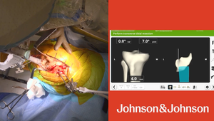 Partial Knee Arthroplasty with VELYS UKA & SIGMA™ HP Uni - Tibial ...