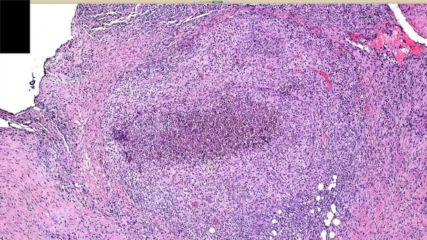 AFB Infection (Mycobacterium Chelonae) – Suppurative Granuloma with ...
