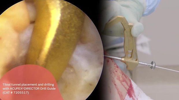 Single Tendon Hamstring ACL Reconstruction with Dual Cortical Button ...