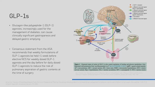 asa statement on glp 1 Perioperative management of patients taking glucagon-like peptide-1 receptor agonists: a restrictive fasting regimen is not necessary. Comment Br J Anaesth 2025; 135: 48–78 American Society of Anesthesiologists Consensus-Based