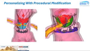 Optimal Planning for TAVR Procedures | Vumedi