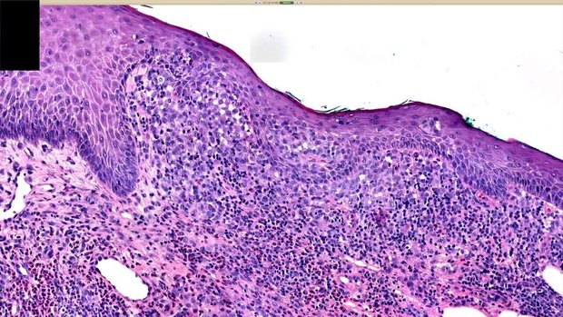 Langerhans Cell Histiocytosis of Skin (LCH) Pathology Histology ...