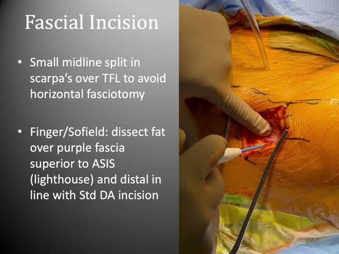 Bikini Incision in Direct Anterior Total Hip Arthroplasty | Vumedi