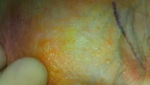 Small Temporal Scalp Incision Browplasty With Internal Suture Browpexy ...