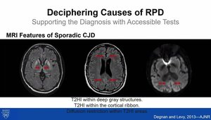 Rapidly Progressive Dementias: Causes, Consequences, and Curable ...