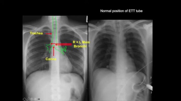 Chest X-Ray Signs: Recognizing Lobar Collapse, Pleural Effusion, and ...
