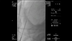 Epicardial LARIAT Closure of a Peri-Device LAA Leak | Vumedi