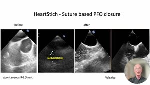 Minimal-Footprint PFO Closure: State of the Art & Future Concepts | Vumedi