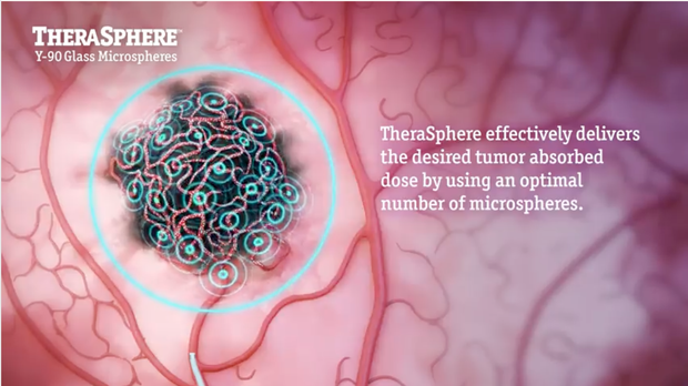 TheraSphere Mechanism of Action Explained | Vumedi